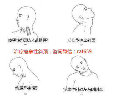 痉挛性斜颈的最新治疗,痉挛性斜颈的最新治疗，痉挛性斜颈的最新治疗方法研究及进展